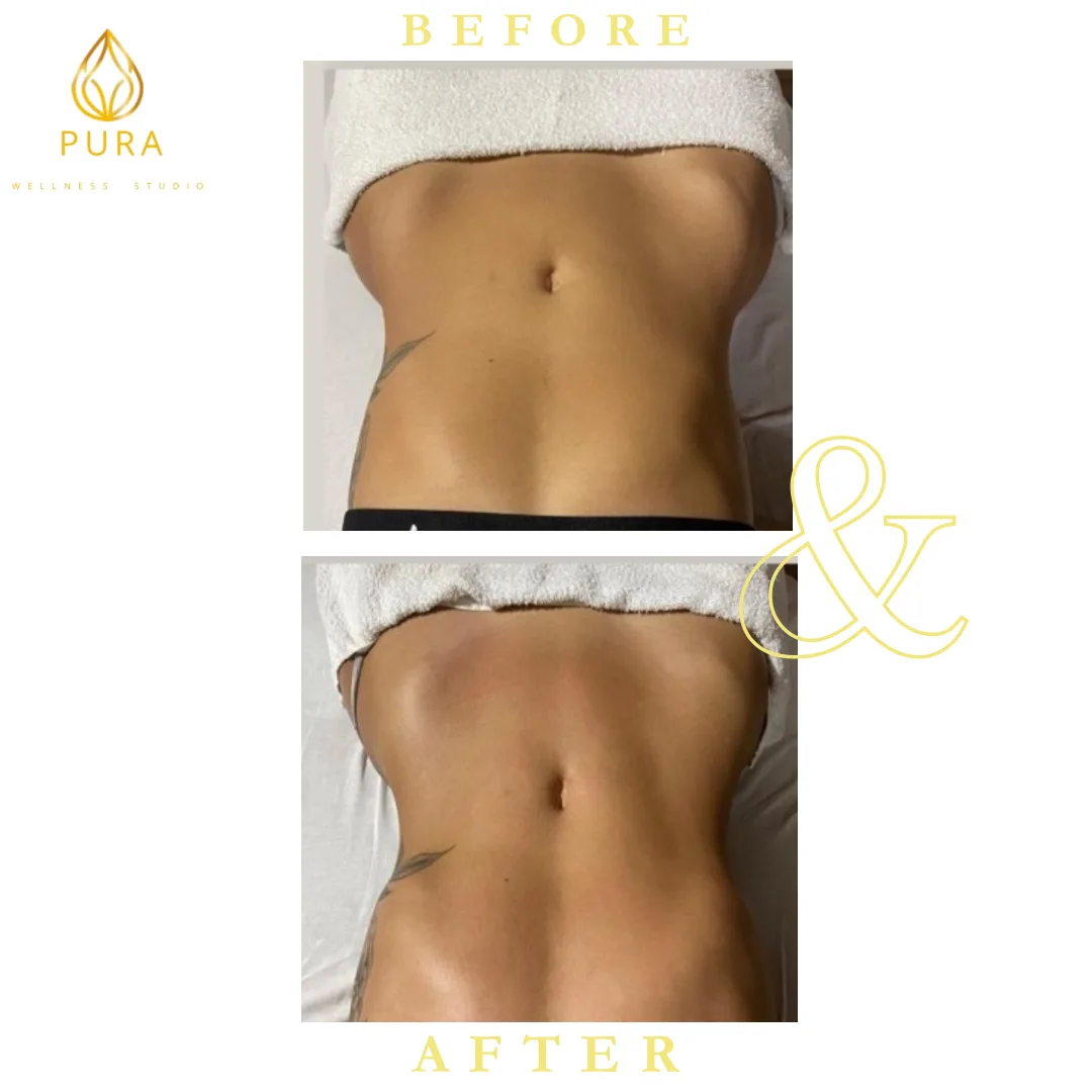 PURA LYMPH Wellness Studio | Lymphatic Drainage + Body Sculpting